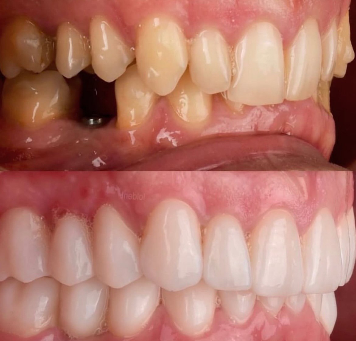 Veneers + Implant Restoration