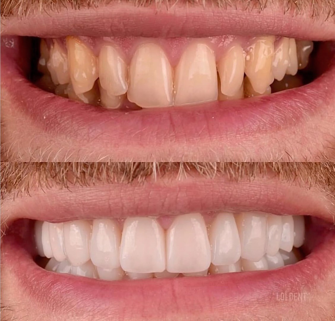 Aesthetic Rehabilitation