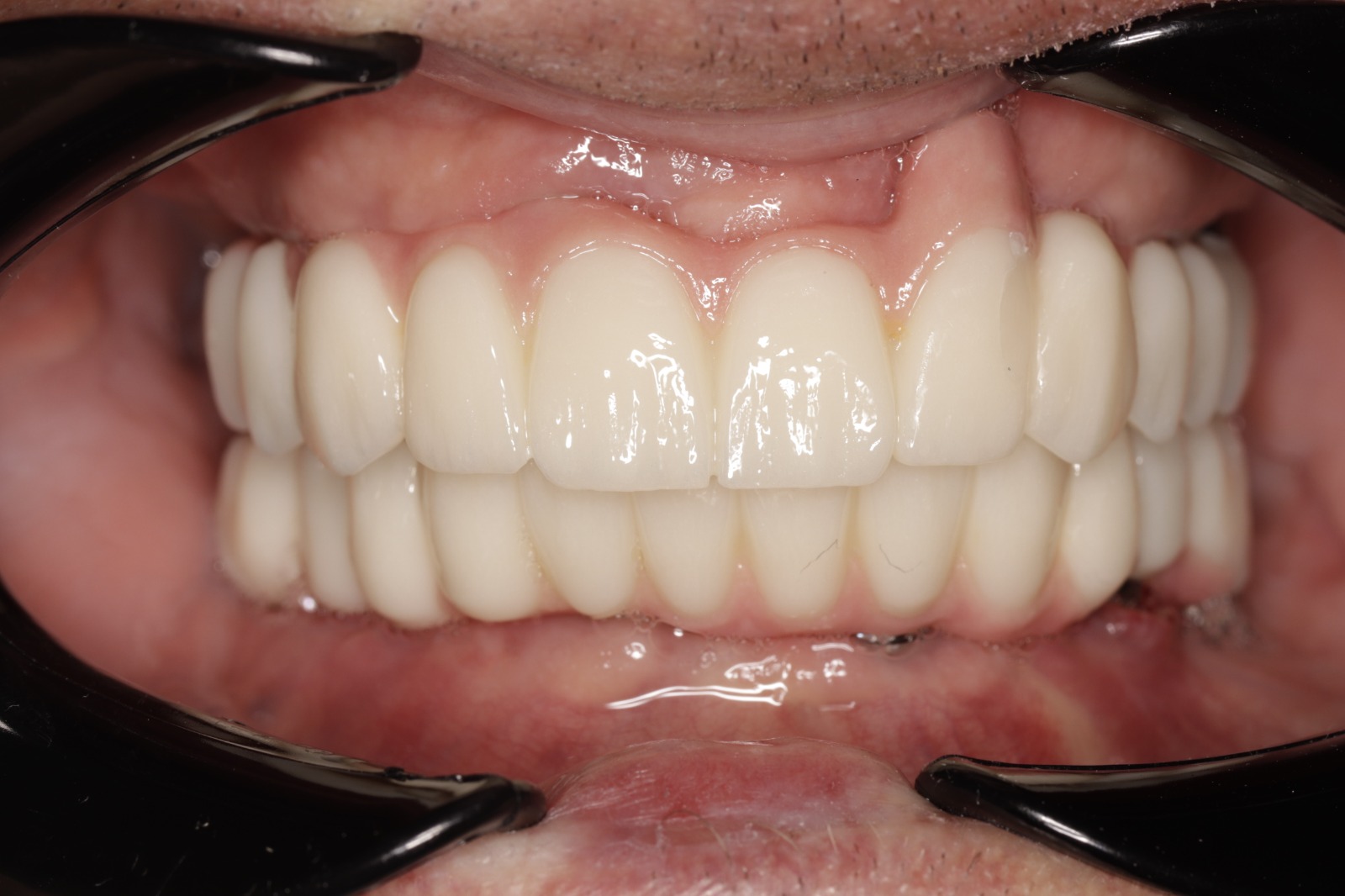 All-on-6 Implant Bridge